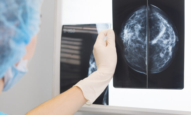 Breast Density and BMI Both Play a Role in Breast Cancer Risk
