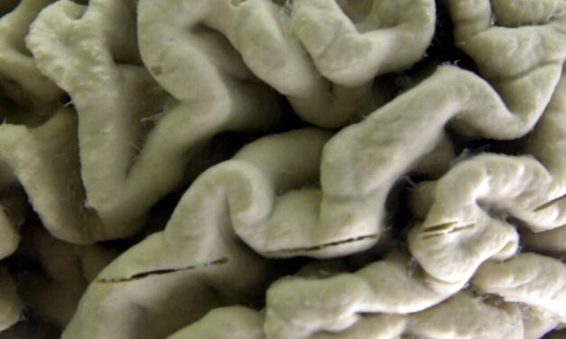 Alzheimer’s disease is more prevalent in these parts of the US