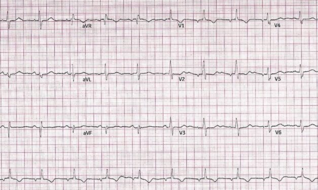 Cardiology Case Report: Older Man with Near Syncope