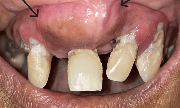 A Painless Bump: A Case Report of Cemento-Ossifying Fibroma of the Anterior Maxilla