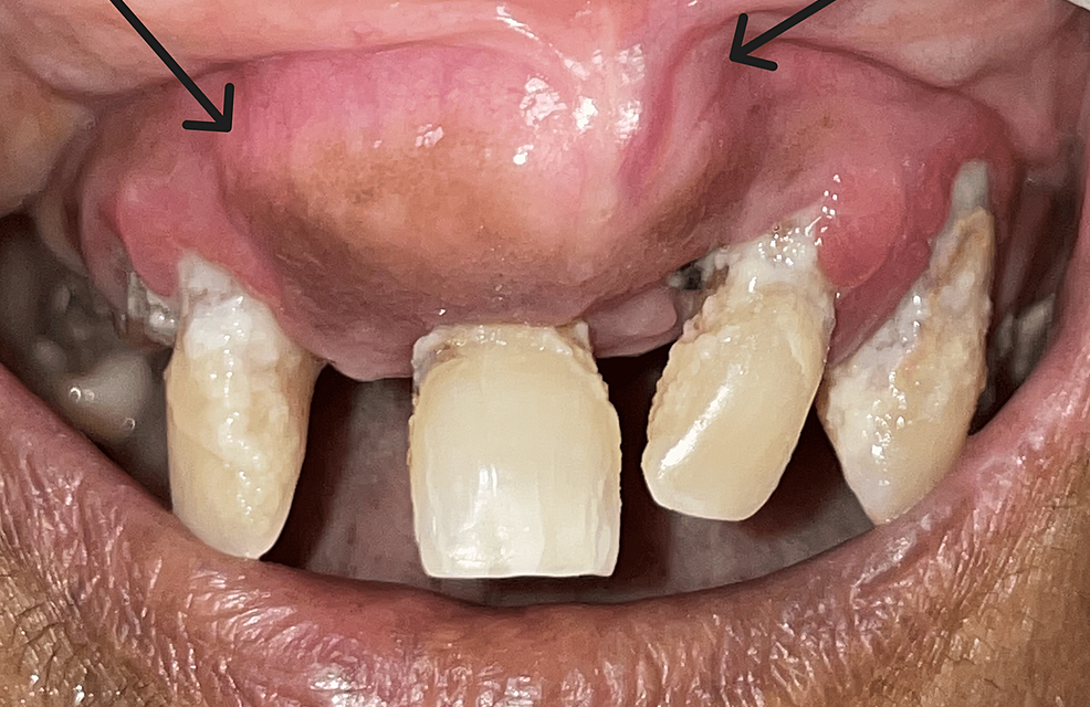 A Painless Bump: A Case Report of Cemento-Ossifying Fibroma of the Anterior Maxilla