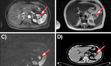 Frantz Tumor: A Case Report of Solid Pseudopapillary Tumor of Pancreas