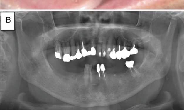 Medication-related osteonecrosis of the jaw without osteolysis on computed tomography: a retrospective and observational study