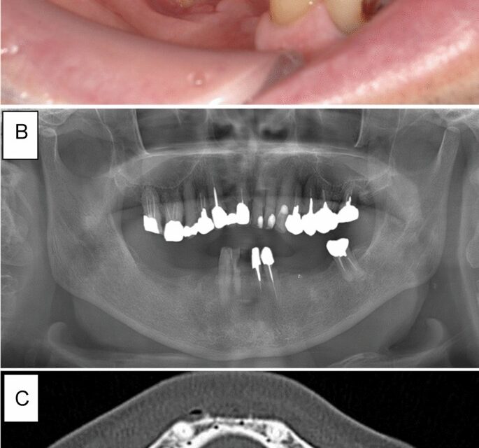 Medication-related osteonecrosis of the jaw without osteolysis on computed tomography: a retrospective and observational study