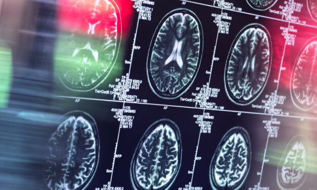Where You Live Shapes How Alzheimer’s Affects You