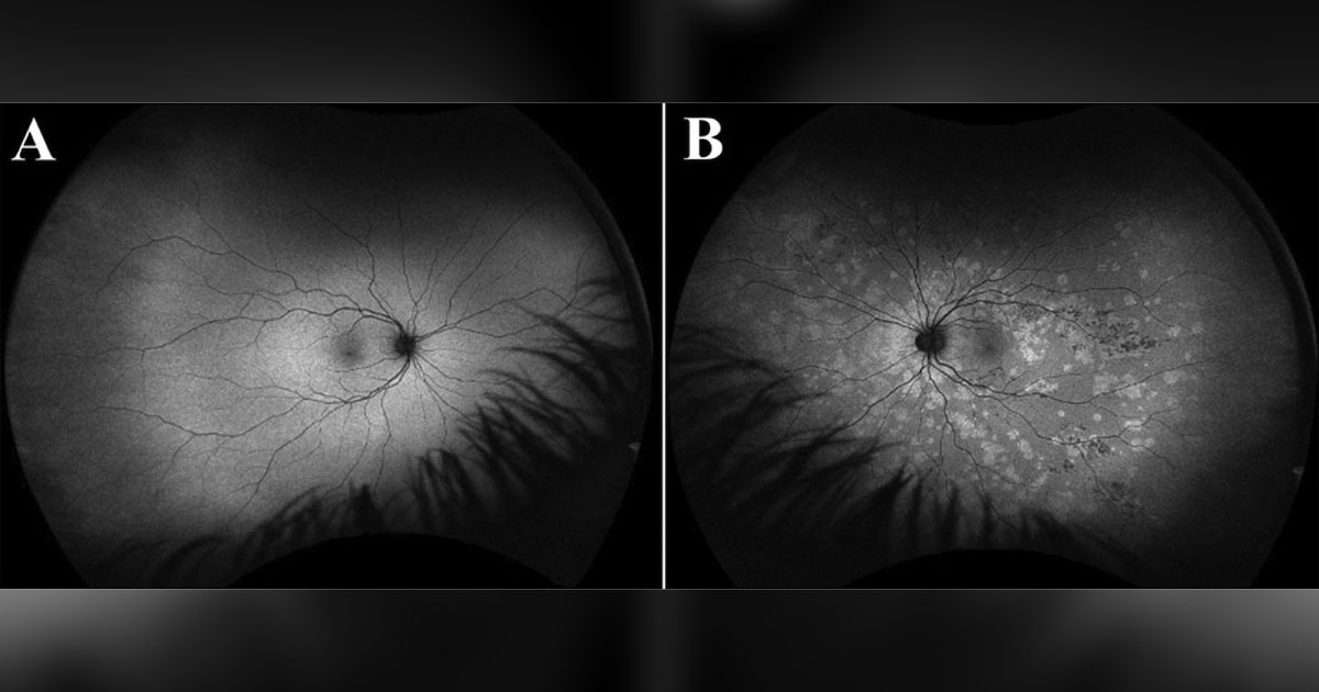 FAF of the right eye (a) is unremarkable, while FAF of the left eye (b) shows numerous hyperautofluorescent spots