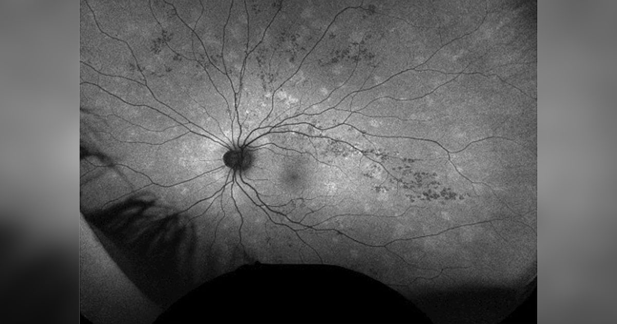 FAF of the left eye shows interval improvement of multiple hyperfluorescent spots in the peripapillary and mid-peripheral retina