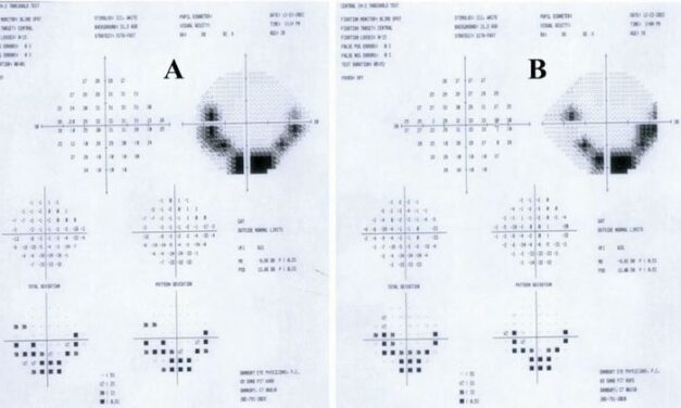 Woman referred for black spot in left eye
