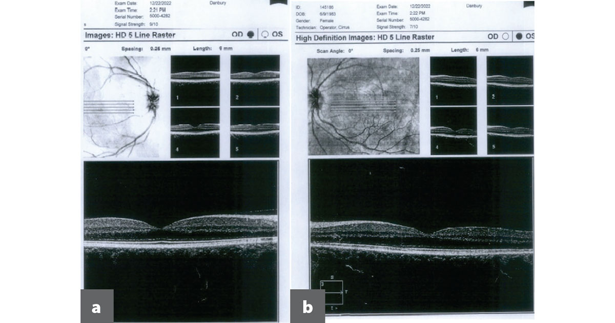 OCT macula of the right eye (a) shows normal foveal contour and preservation outer retinal layers. OCT macula of the left eye (b) shows possible IS/OS disruption parafoveally nasally