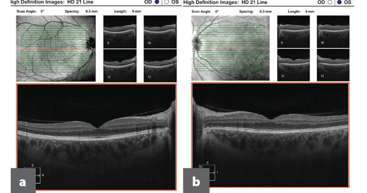 OCT macula of the right eye (a) shows normal foveal contour and preserved outer retinal layers. OCT macula of the left eye (b) shows discrete IS/OS disruption