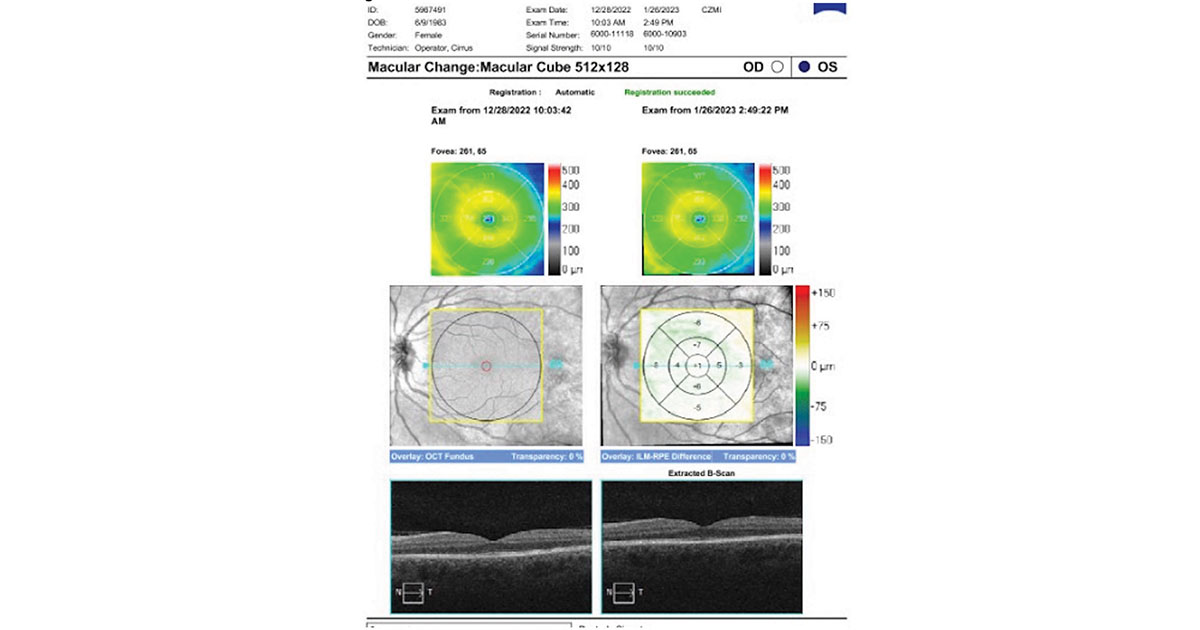 OCT macula of the left eye shows near reconstitution of the previously noted outer retinal disruption
