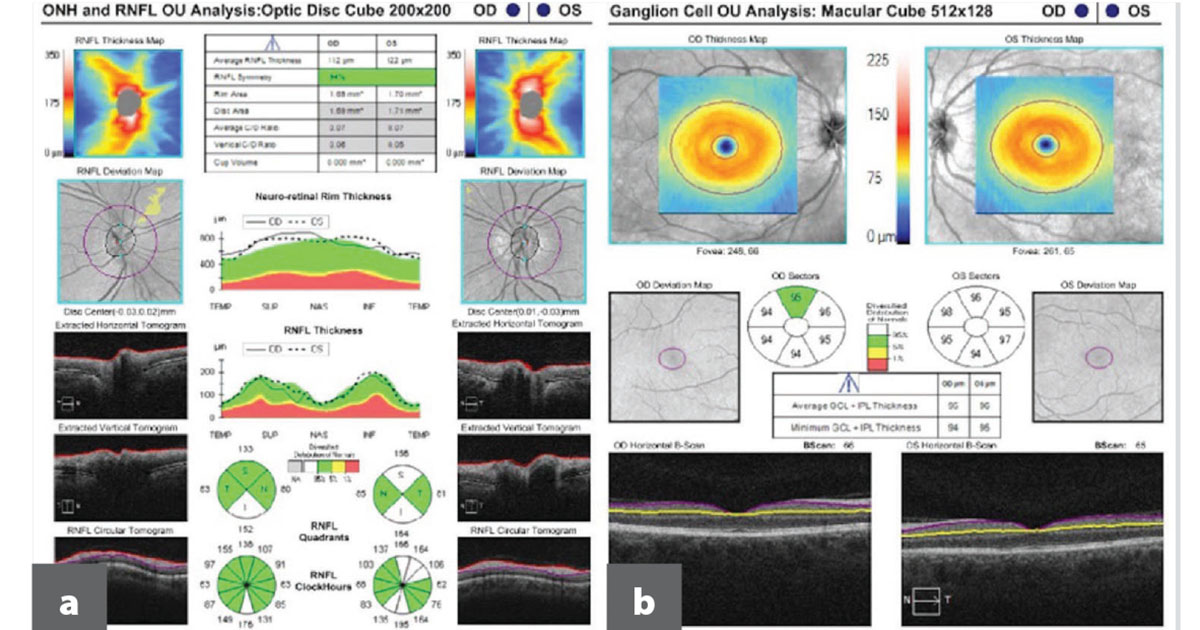OCT RNFL (a) and ganglion cell analysis (b) of the right and left eyes are within normal limits