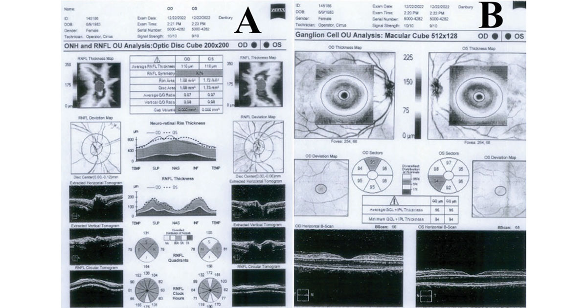 OCT RNFL (a) and ganglion cell analysis (b) of the right and left eyes are within normal limits