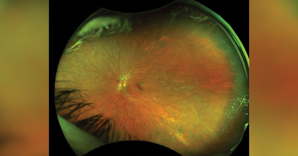 Optos color fundus photo of the left eye shows improved appearance of the multifocal white dots