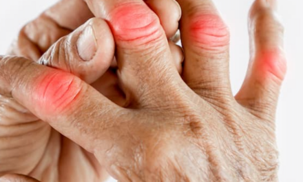 Higher Baseline Serum Urate Levels Linked to Higher Risk of Gout Flare