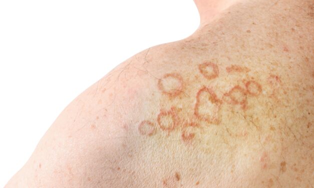 Advances in Diagnosing and Treating Atopic Dermatitis in the Elderly