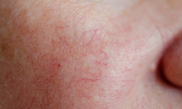 Broken Blood Vessels on Your Face? Dermatologists Reveal How To Erase Them for Flawless Skin, Fast