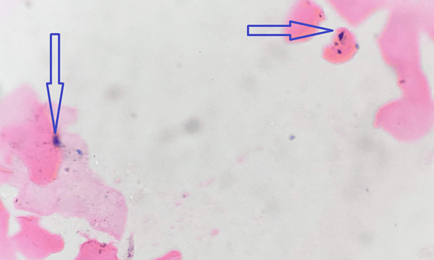 Utility of Perl’s Prussian Blue Stain in Exfoliated Buccal Cells of Thalassemia and Sickle Cell Anemia Patients and Their Correlation With Serum Ferritin Levels