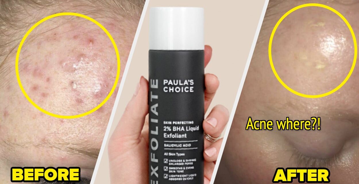 If You’re Dealing With Cystic Acne, Reviewers Say These 22 Products Helped Theirs
