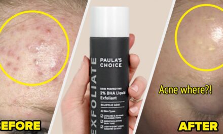 If You’re Dealing With Cystic Acne, Reviewers Say These 22 Products Helped Theirs
