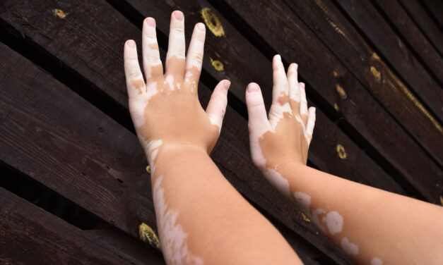 Meta-Analysis Finds Chinese Patent Medicines May Be Efficacious, Suitable Interventions for Vitiligo