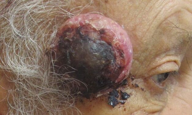 Mohs Surgery Improves Rates of Nodal Metastasis and Disease Specific Death in cSCC