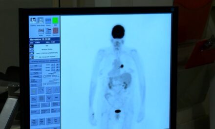 Scan looks to detect lung cancer at earlier stages