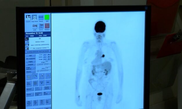 Scan looks to detect lung cancer at earlier stages