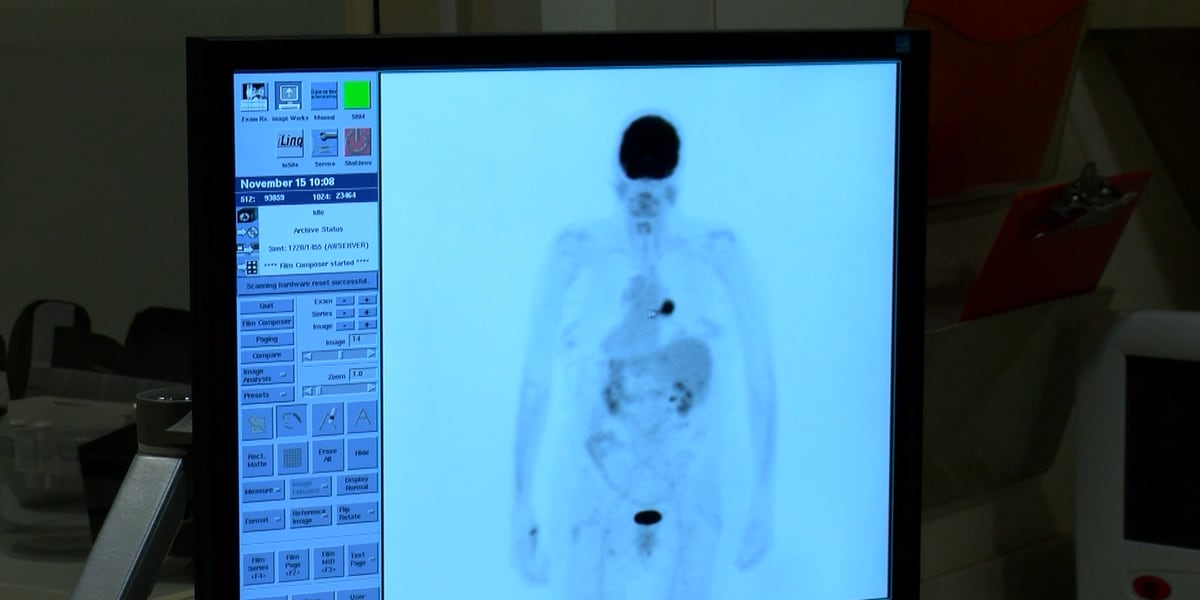 Scan looks to detect lung cancer at earlier stages