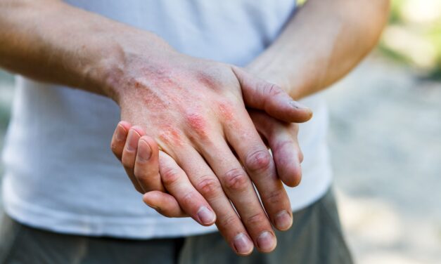 Older, Middle-Aged Adults With Atopic Dermatitis Face an Increased Risk of Cognitive Dysfunction
