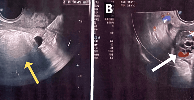 Gangrenous Ovarian Cyst Torsion During Pregnancy: A Rare Case Report