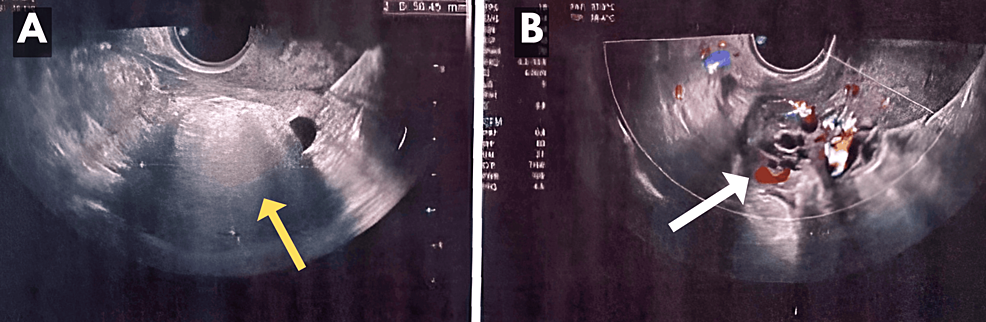 Gangrenous Ovarian Cyst Torsion During Pregnancy: A Rare Case Report